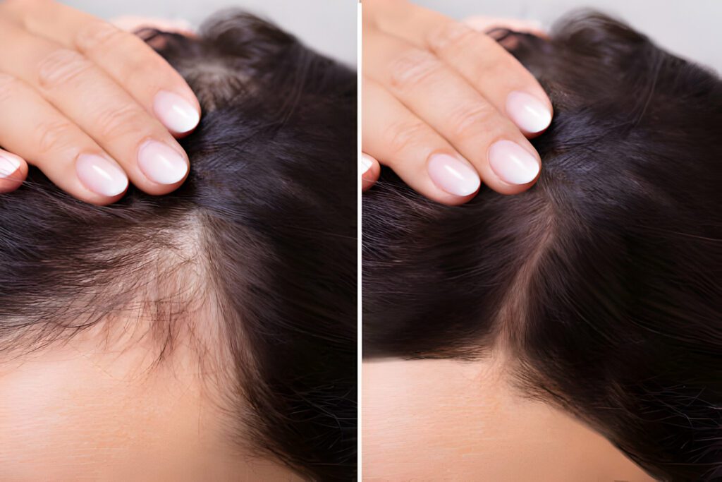 الطرق الطبيعية لعلاج تساقط الشعر