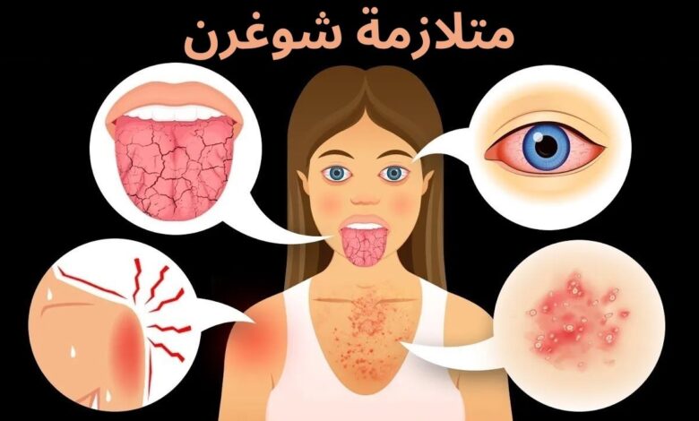 متلازمة شوغرن